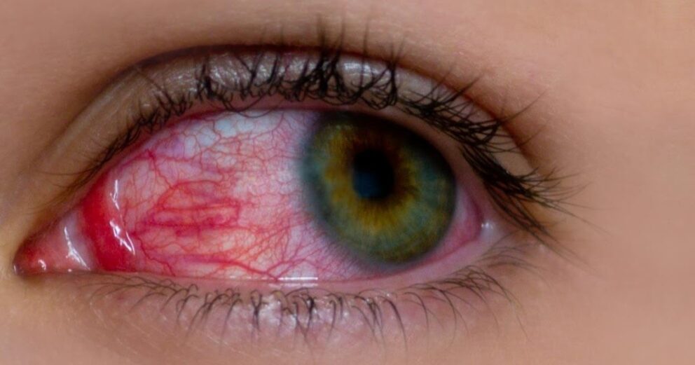 फैलिँदै आँखा पाक्ने रोग : के गर्ने, के नगर्ने ?