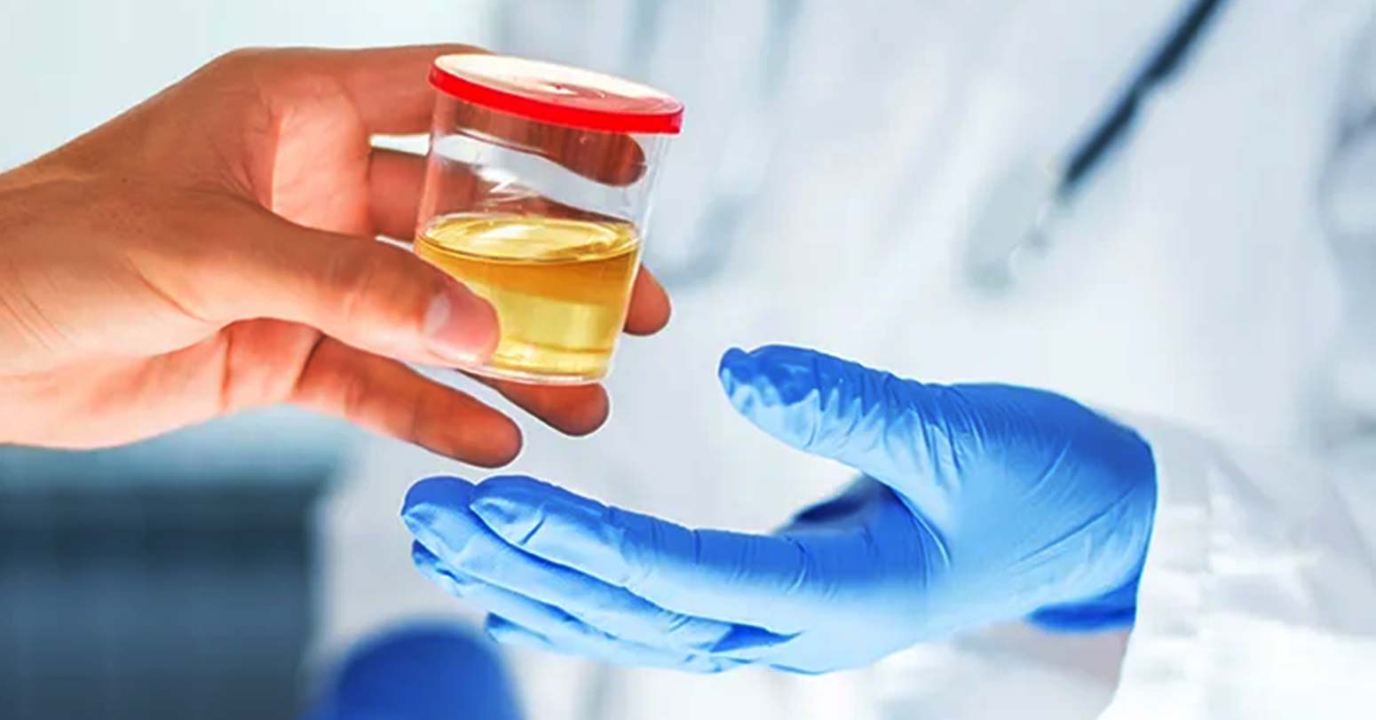 कुन अवस्थामा गरिन्छ पिसाब जाँच ?